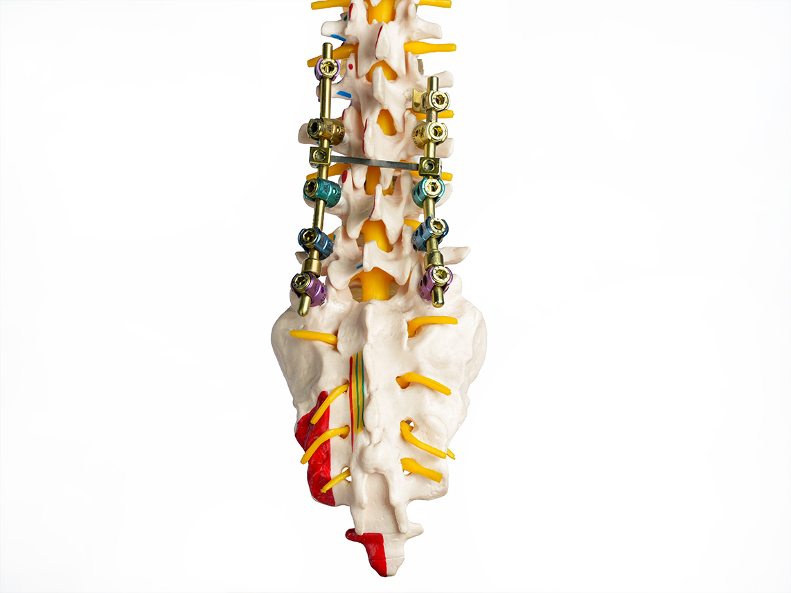 Lumbar Fixation System