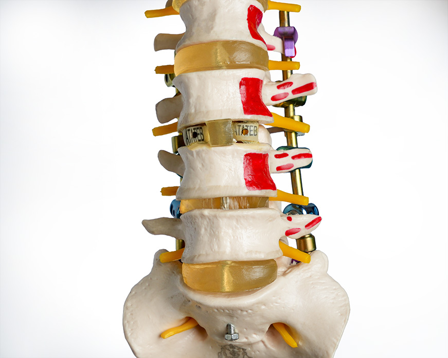 Lumbar Interbody Cages