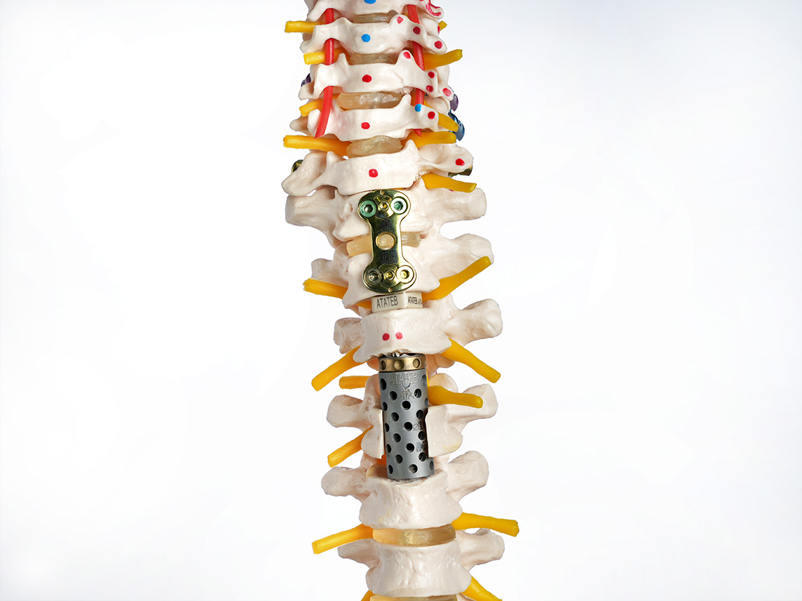 Cervical Interbody Cages